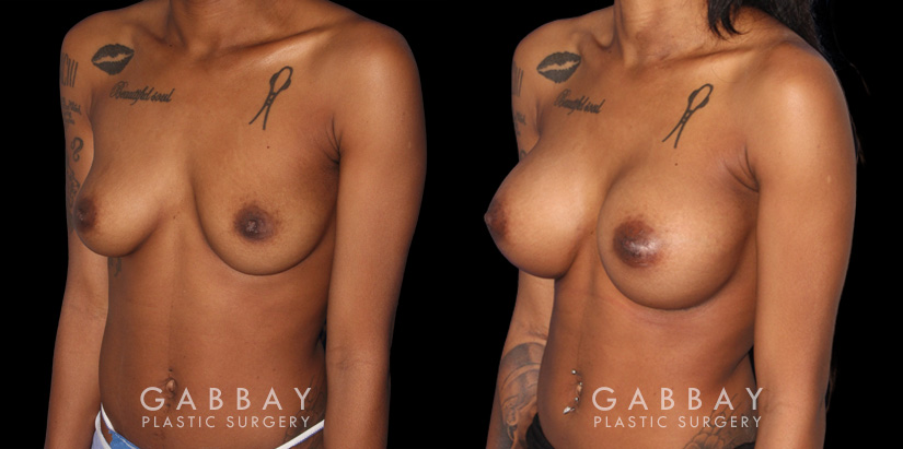 Patient with significant breast volume increase through breast augmentation with silicone implants. Profile view demonstrates the enhanced breast size by silhouette with an alluring, round shape.