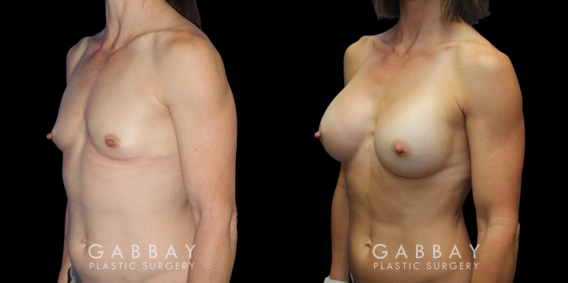 Breast augmentation results for patient with slim and fit body type. The silicone implants were chosen to match this tighter physique for a natural balance.