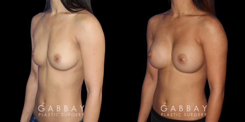 Before-and-after photos for breast augmentation showing fully recovered patient. Note the lack of visible scarring despite the dramatic increase to bust volume. Balanced, round breast shape enhances the patient’s natural figure.