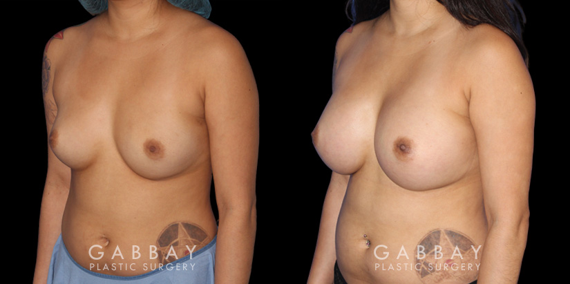 Following a smooth recovery, the patient’s silicone implants settle well to produce a round breast shape with increased volume. The breasts sit comfortable without the position being altered.