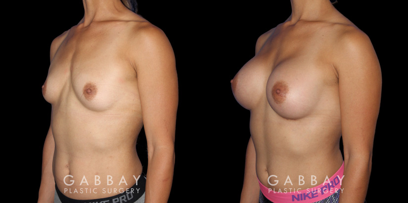 Patient recovered without complication and maintained a round, pleasing shape to her breasts. Scarring is hidden in the breasts natural folds, displaying only her positive results.