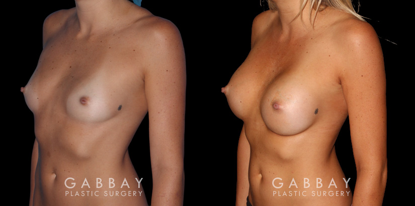 Breast augmentation before-and-after photos for patient with silicone implants. Increased volume resulted in pleasantly round breasts without excessive change.