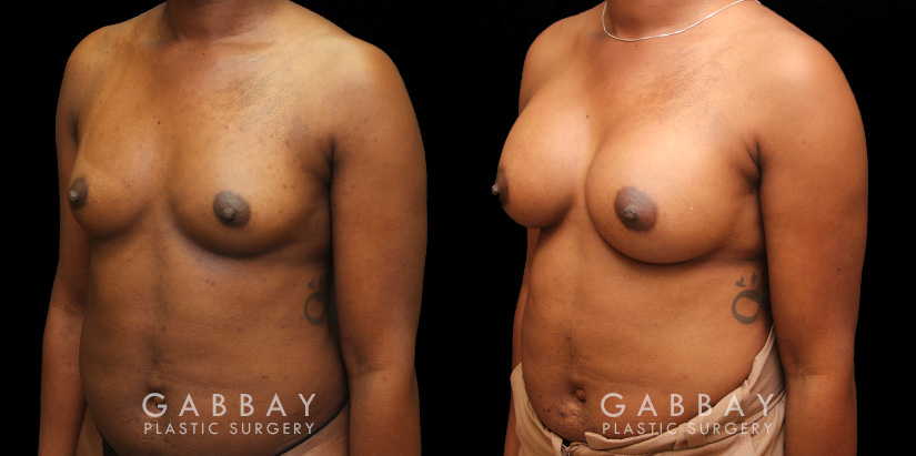 Patient before and after receiving silicone implants to increase breast roundness and overall volume. Results are shown following complete, smoother recovery.