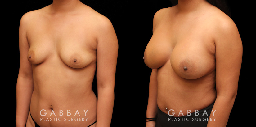 Photos for female patient before and after silicone implant procedure. Note the robust increase in breast size while continuing to match her body's aesthetic for an aligned appearance.