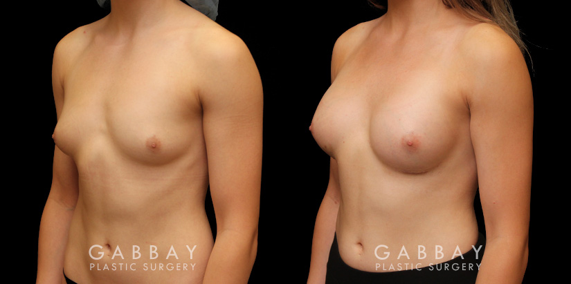 Patient wanted very mild breast augmentation to improve the roundness and curve of breasts. Results show increase from minimal breast shape to a gentle rounding slope to the breasts.