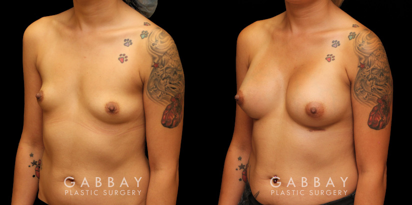 Silicone implants were used to increase breast roundness and volume. Note how the breasts kept their position while filling out for a balanced appearance.