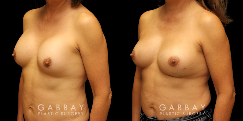 Patient before-and-after photos for implant removal and replacement procedure. This revision breast augmentation went well and patient was satisfied with how her new implants looked and felt.