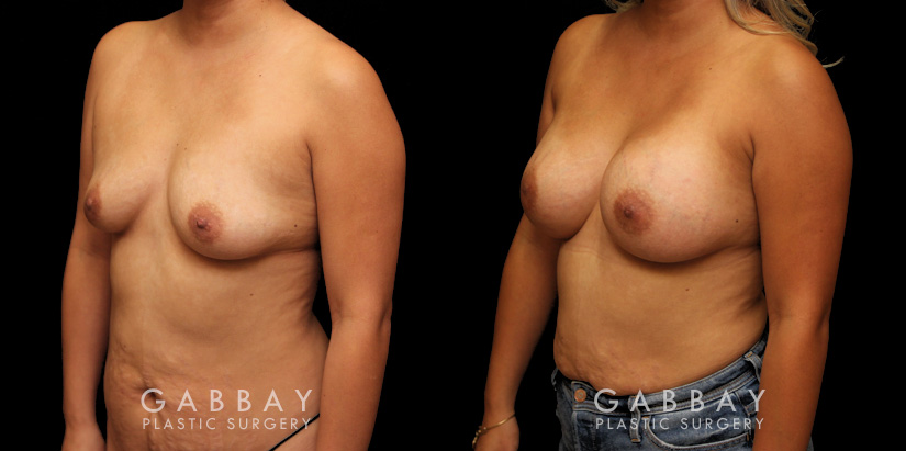 Before-and-after photos for female patient with breast augmentation. Classic results show improved size and volume of breasts with enhanced roundness from each angle.