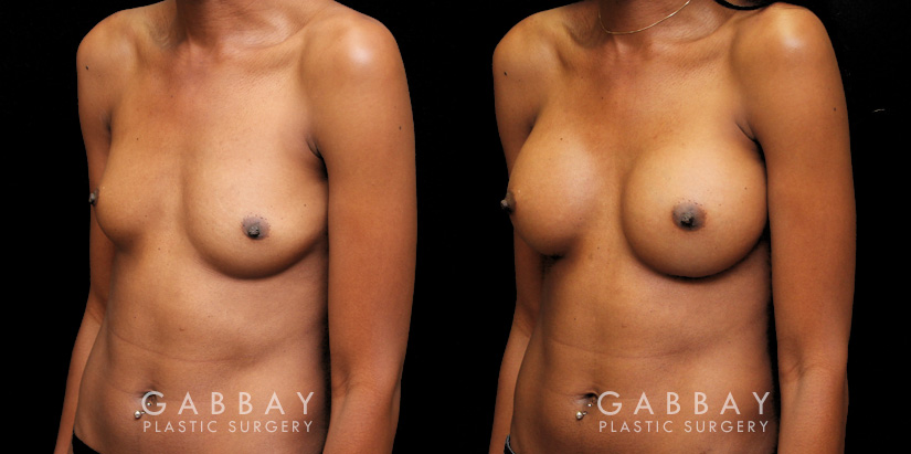 Patient 09 3/4th Left Side View Breast Augmentation with Silicone Implants Gabbay Plastic Surgery