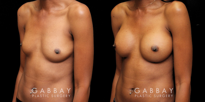 Patient before-and-after photos for breast augmentation with silicone implants. Patient increased cup size while maintaining a natural, balanced look to the breasts.