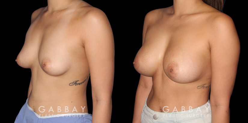 Female patient in her 20s before-and-after revision breast augmentation, including implant removal and replacement with additional breast lift to improve breast position.