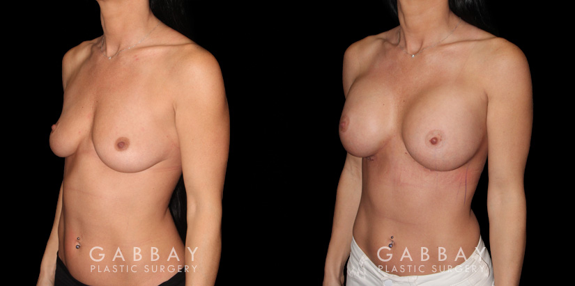 Patient breasts with silicone implants following complete recovery. Now how the incisions are hidden in the breast folds, making them invisible from most angles.