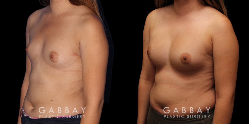Patient wanted to achieve notable breast enlargement without passing a natural boundary. So we used mild silicone implants to boost breast contour and roundness while keeping the results looking natural.