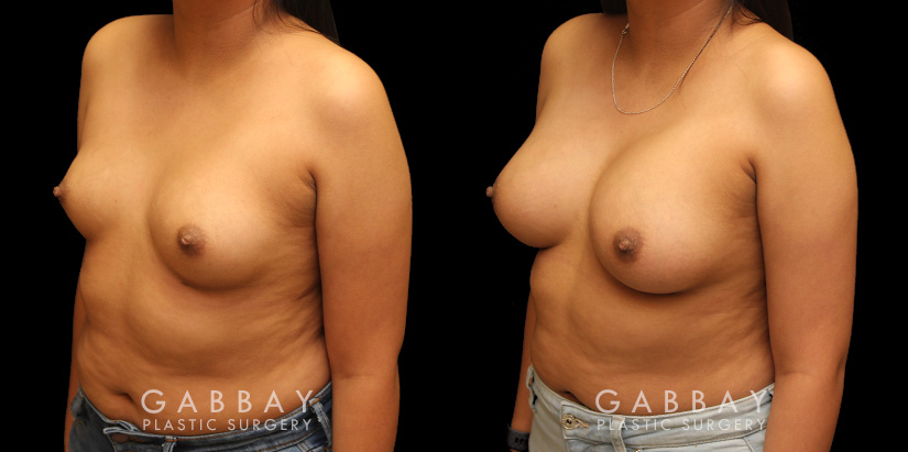 Using silicone implants, patient wanted a mild boost to breast volume without dramatic results. The final look has enhanced roundness while keeping to the patient’s natural breast shape and position before the procedure.