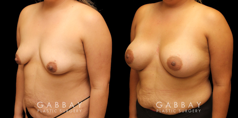 Silicone implant results. Patient increased breast size and used the implants to reduce breast drooping as well, without the need for mastopexy in addition.