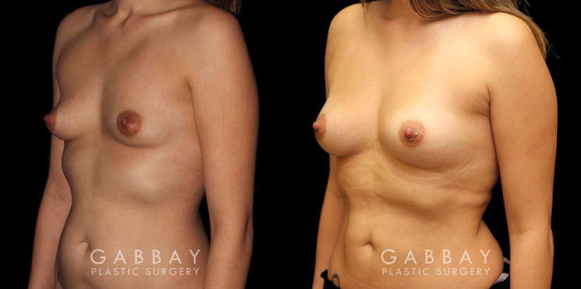 Patient 01 3/4th Left Side View Breast Fat Grafting Gabbay Plastic Surgery