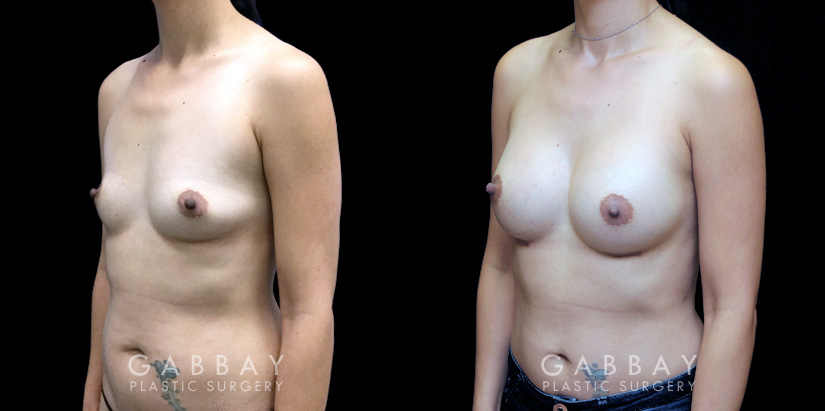 Breast Augmentation – Silicone