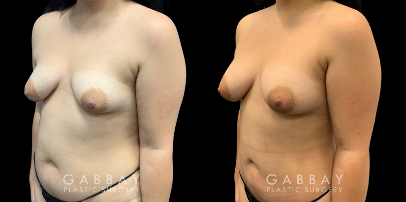 Patient 04 3/4th Left Side View Breast Fat Grafting Gabbay Plastic Surgery