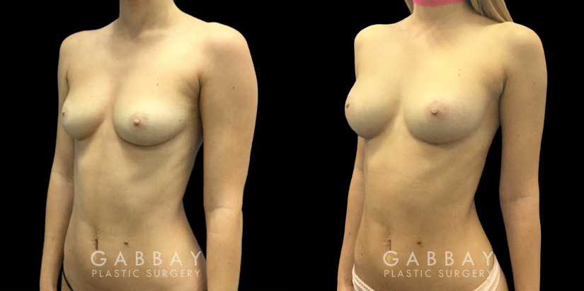 Patient 06 3/4th Left Side View Breast Fat Grafting Gabbay Plastic Surgery