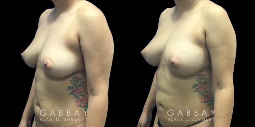 Patient 08 3/4th Left Side View Breast Fat Grafting Gabbay Plastic Surgery