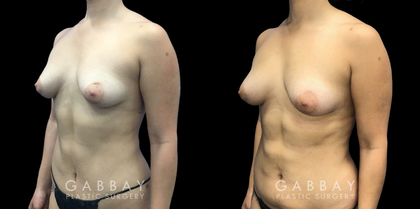 Patient 09 3/4th Left Side View Breast Fat Grafting Gabbay Plastic Surgery