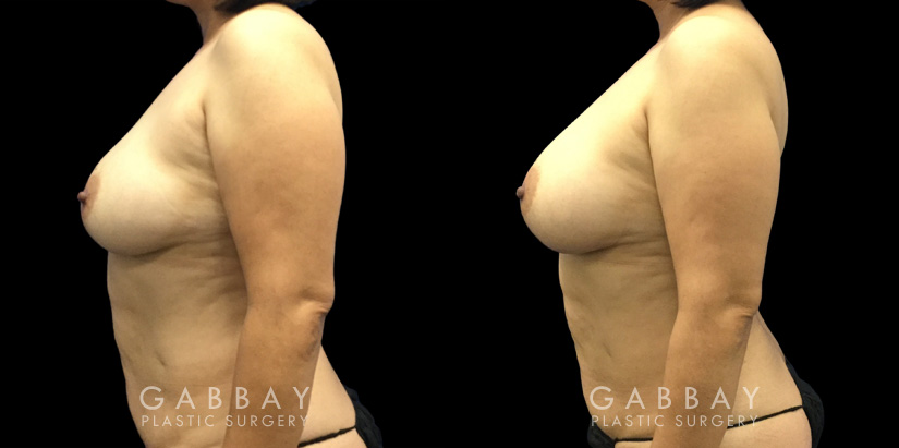 Patient 10 Left Side View Breast Fat Grafting Gabbay Plastic Surgery