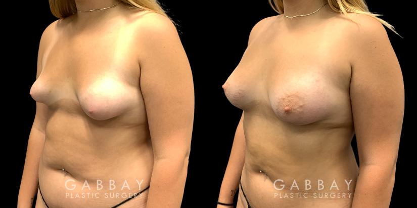 Patient 11 3/4th Left Side View Breast Fat Grafting Gabbay Plastic Surgery