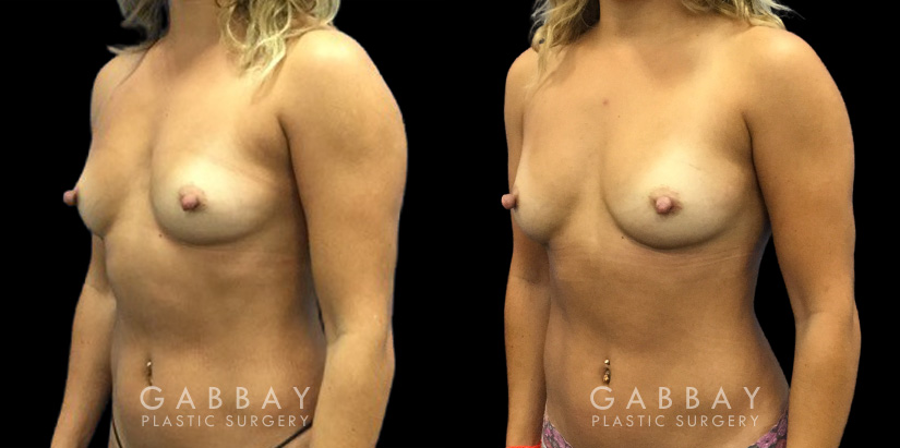 Patient 12 3/4th Left Side View Breast Fat Grafting Gabbay Plastic Surgery