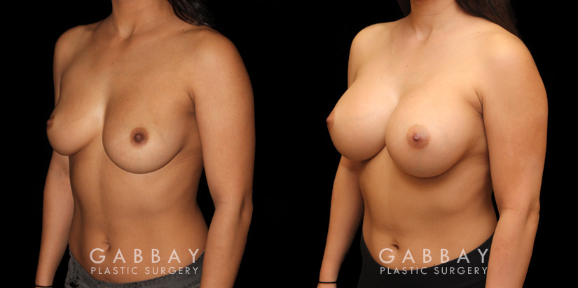 This is a breast augmentation patient who had significant asymmetry. She underwent silicone breast implant augmentation, using different sized high profile Allergan Natrelle Soft Touch implants: 365 cc on the left, 435 cc on the right. Implants were placed below the muscle in a dual plane configuration using an incision that is beautifully hidden within the breast fold.