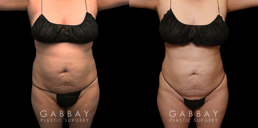 Abdominal liposuction results for female patient who wanted to address stubborn belly fat that did not respond to diet and exercise. Results show reduced overall profile that also lends itself to her natural body shape and features.