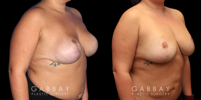 Patient 03 3/4th Right Side View Revision Breast Reduction, Revision Wide Mastopext, Belladerm Gabbay Plastic Surgery
