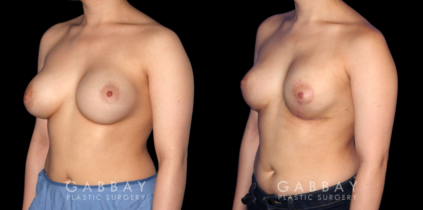 Patient 06 3/4th Left Side View Breast Augmentation-Remove and Replace Saline & Full Lift Gabbay Plastic Surgery