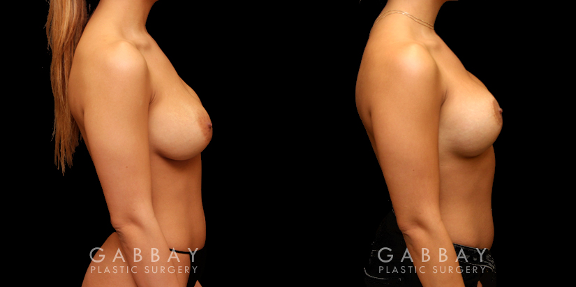 Patient 13 Right Side View Removal and Replacement of SIL Implants Capsulorrhaphy Gabbay Plastic Surgery