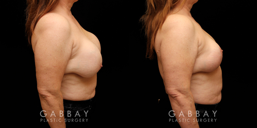 Patient 17 Right Side View Implant Removal and Lift Gabbay Plastic Surgery