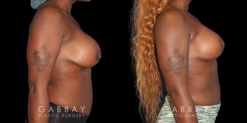 Patient 18 Right Side View Breast RevisionGabbay Plastic Surgery