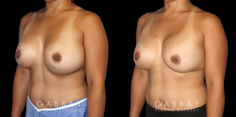 Patient 19 3/4th Left Side View Breast Revision Gabbay Plastic Surgery