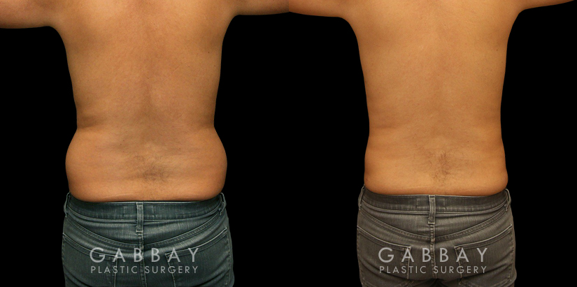 Male liposuction results after reducing stubborn belly fat that would not respond to diet or exercise. The belly area went from significant overhang above the beltline to a flatter contour.