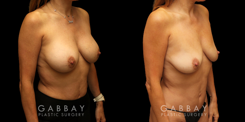 Patient 07 3/4th Right Side View Mini Tummy Tuck and Lipo to Waist Gabbay Plastic Surgery