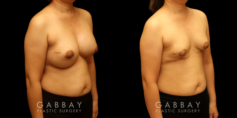 Patient 09 3/4th Right Side View Breast Implant Removal and Lift Gabbay Plastic Surgery