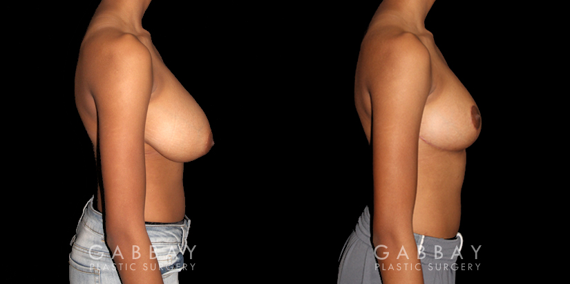 Patient 02 Right Side View Breast Reduction Gabbay Plastic Surgery