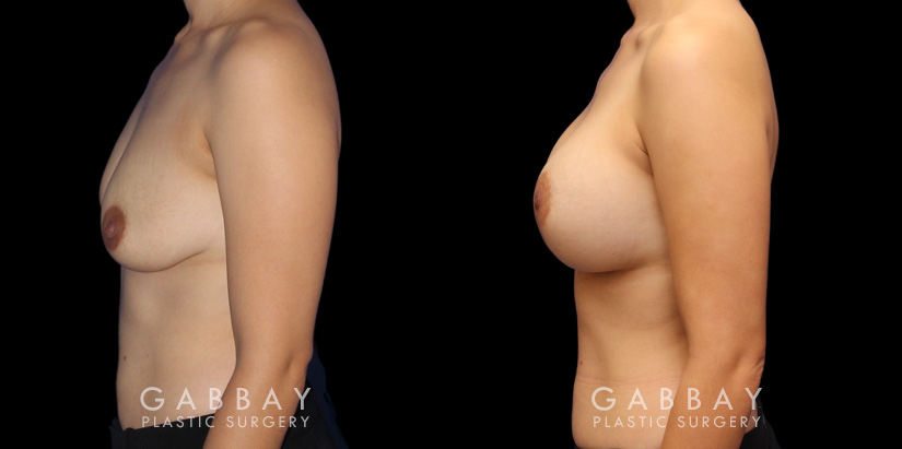 Patient 11 Left Side View Scar Revision to Breasts Gabbay Plastic Surgery