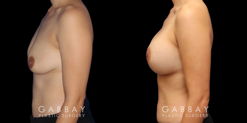 Scar revision to breasts results with additional breast augmentation and lift combination. Patient improved breast size and position with mild scarring only.