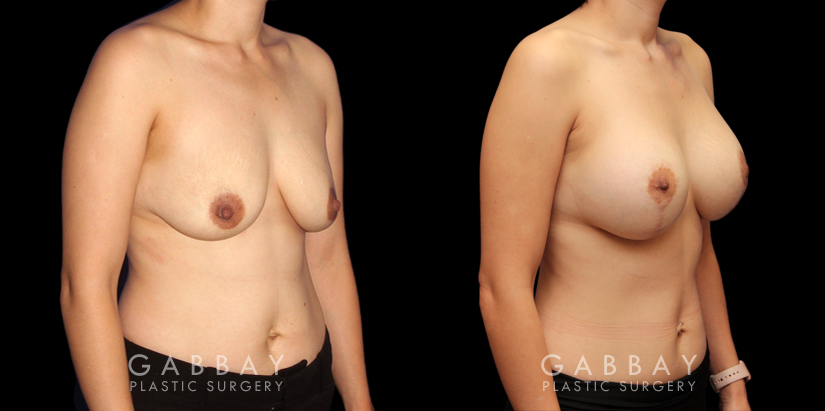 Scar Revision to Breasts