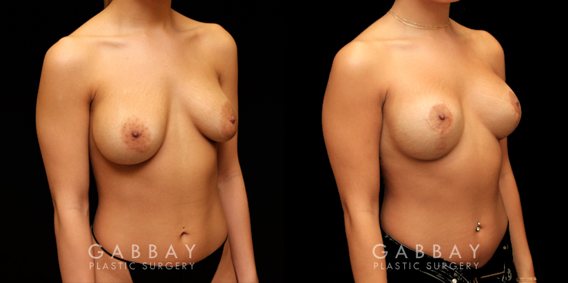 Patient 09 3/4th Right Side View Removal and Replacement of SIL Implants Capsulorrhaphy Gabbay Plastic Surgery