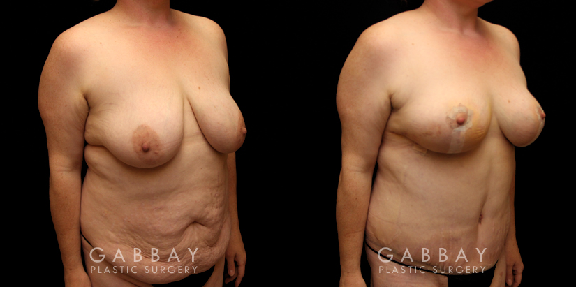 Tummy Tuck and Breast lift