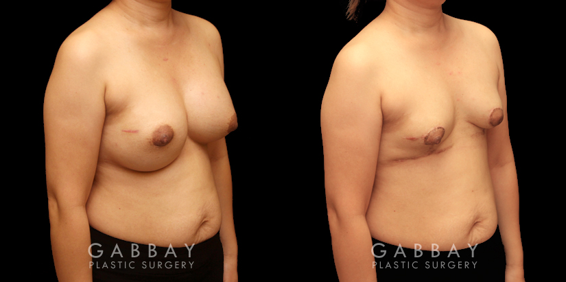 Patient 13 3/4th Right Side View Breast Implant Removal and Lift Gabbay Plastic Surgery