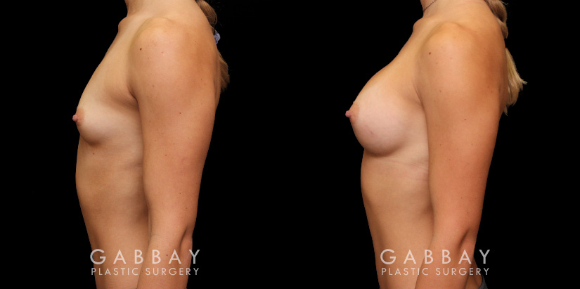 Patient before and after breast augmentation with silicone implants for both breasts. Patient’s naturally slender body type balanced well with smaller implants.