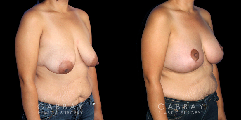 Patient 18 3/4th Right Side View Breast Augmentation Silicone, Mastopexy Gabbay Plastic Surgery