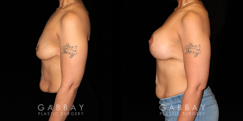 Breast Augmentation – Silicone & Lift