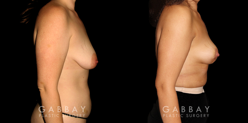 Patient 21 Right Side View Mastopexy and Liposuction Gabbay Plastic Surgery
